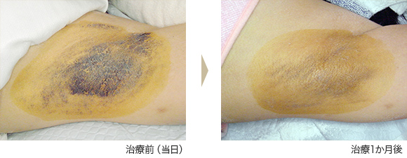 ミラドライ症例 ① K.W様(女性)