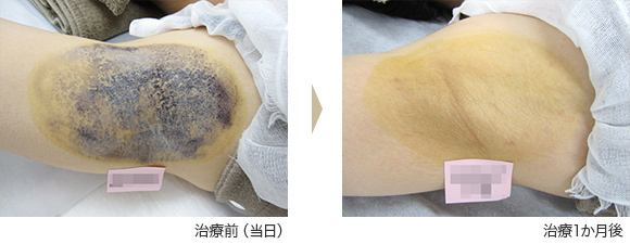 ミラドライ症例 ④ U.M様(女性)