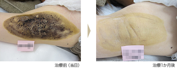 ミラドライ症例 ⑤ T.T様(女性)