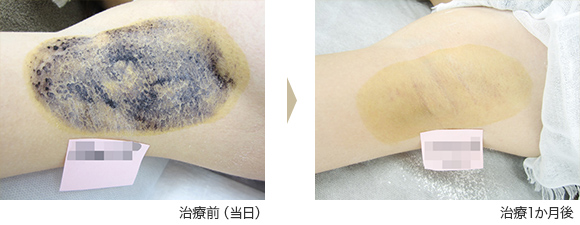 ミラドライ症例 ⑥ T.A様(女性)