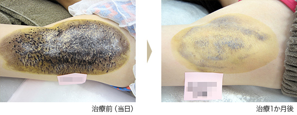 ミラドライ症例 ⑦ S.S様(女性)