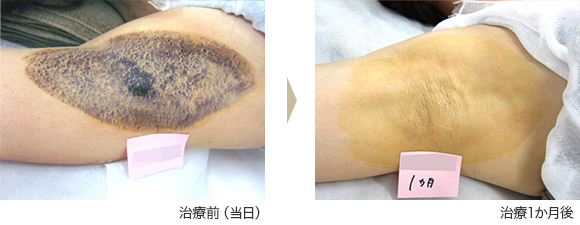 ミラドライ症例 ⑧ F.Y様(女性)