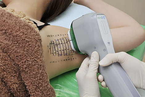 マリアクリニックのミラドライは独自の治療方法で副作用を大幅に軽減